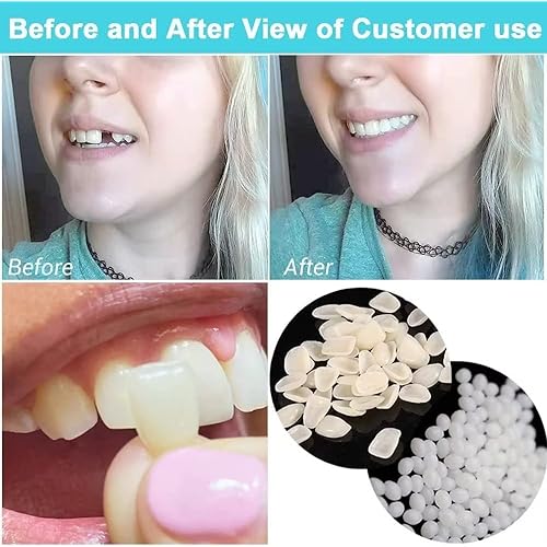 Womcare Temporary Tooth Repair kits for Filling The Missing Broken Tooth and Gaps-Moldable Fake Teeth and Thermal Beads Replacement Kits