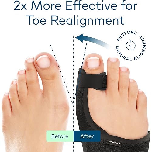 Bunion Corrector for Women & Men 2pc - Big Toe Separator for Bunion Relief - Toe Spacers for Feet - Straightening Orthopedic Bunion Splint for Hallux Valgus - Foot Care Day & Overnight